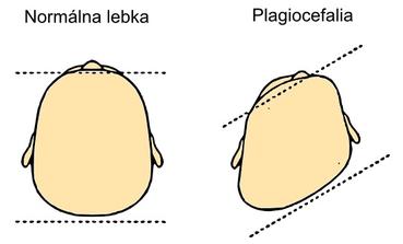 polohová plagiocefália